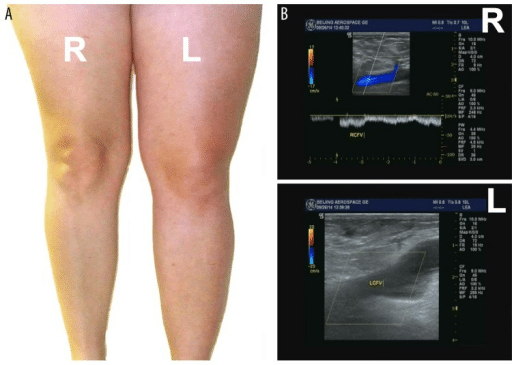 Leg swelling and US side by side