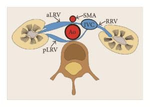 Nutcracker anatomy circumaortic