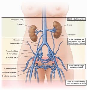 Pelvic venous anatomy Pelvic venous anatomy